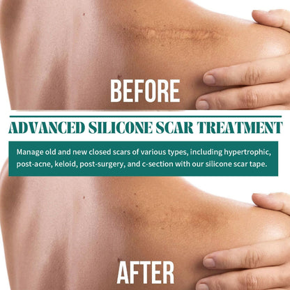 Seurico™-Professional Silicone Scar Sheets king- Scars Removal Treatment-Anti-Aging